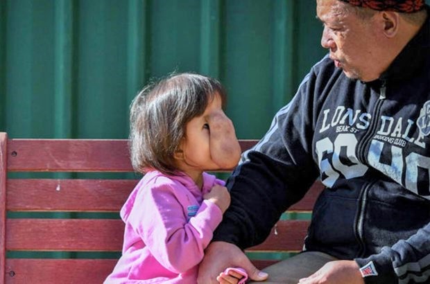 Beyin anomalisi ile doğan Filipinli Angel, Avustralya’da sağlığına kavuştu